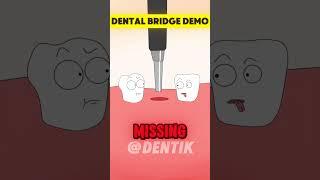 Want a Perfect Smile? Learn the Dental Bridge Process Now