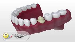 Ineos cad cam crowns in the Philippines