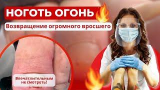 Ноготь Огонь: возвращение Огромного вросшего