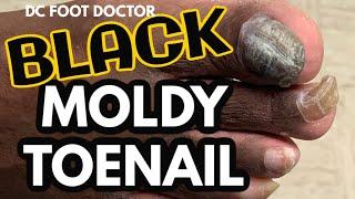 Black Mold located under Fungal Toenail: Black Moldy Toenail: