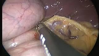 Lap Fundoplication by prof Wael Tobar