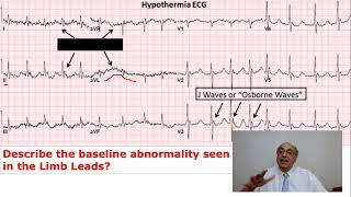 EKG Trainer (Case 39) Answer