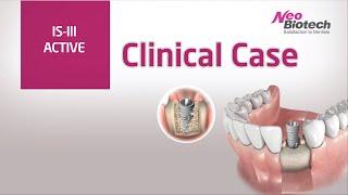 IS III active step by step procedure implant placement