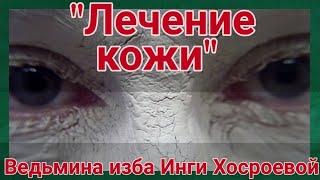 "ЛЕЧЕНИЕ КОЖИ" ДЛЯ ВСЕХ. ВЕДЬМИНА ИЗБА. ИНГА ХОСРОЕВА.