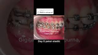 Elastics (rubber bands) for braces - assist braces in moving teeth to the desired position