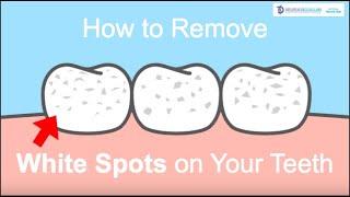 How to Remove White Spots on your Teeth