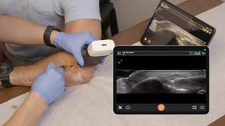 Lateral Epicondyle Injection - Ultrasound Scanning Technique