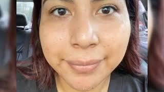 Incredible VI Peel Results