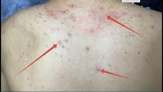 ACNE TREATMENT VU QUYNH MI   Acne On Back FULL 720p