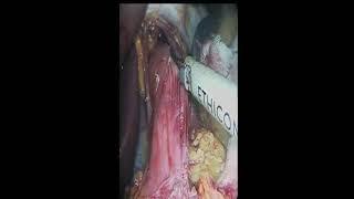 Laparoscopic Heller Cardiomyotomy For Achalasia Of The cardia By WAEL TOBAR MD