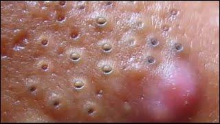 САЛЬНЫЕ ПРОБКИ И ЧЕРНЫЕ ТОЧКИ grease tube and blackheads fascinating video