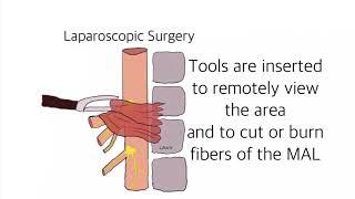 MALS Median Arcuate Ligament Syndrome Surgical Questions