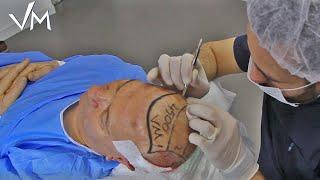 SAPPHIRE FUE METHOD | TURKISH HAIR TRANSPLANTATION