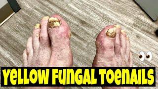 EXTREME TOENAILS TRANSFORMATION : Watch Fungal Nails Turn Healthy Again!