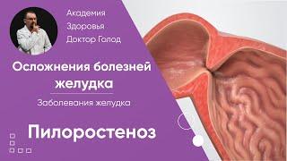 Пилоростеноз - осложнения болезни желудка