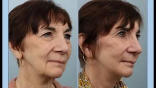 Weekend (Mini) Facelift Patient Testimonial