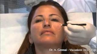 Viscoderm 2,0% 30 Gneedle Dr Gennai