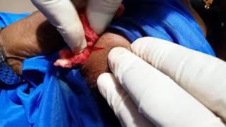 Lancing superficial haematoma ||  8month old infant || #whatilearntoday