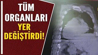 TÜM ORGANLARI YER DEĞİŞTİRDİ!