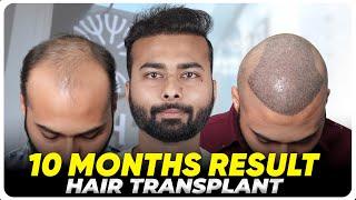 Hair Transplant in Turkey | Best Results & Cost of Hair Transplant in Turkey