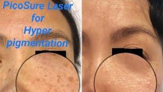 Best laser for pigmentation | picolaser treatment #skinrejuvenation #draqeel #adeelmedics #laser