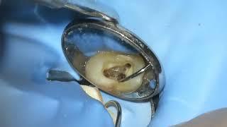 Live: Root Canal / Build-Up / Crown #3 - WaveOne Gold - Dr. Berlin