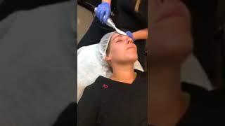 Vibradermabrasion treatment