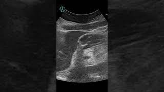 73F，severe epigastric pain. PPU with perforated tract & pneumoperitoneum #ApacheUltrasound