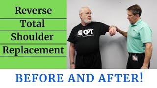 Reverse Total Shoulder Replacement Before & After