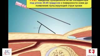 Коронарография сердца: доступы, техника пункции артерий и основные этапы исследования