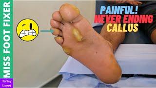 Painful! Never Ending Callus | Miss Foot Fixer | Marion Yau