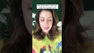 Treat melasma with affordable creams from the pharmacy #shorts #shortsvideo