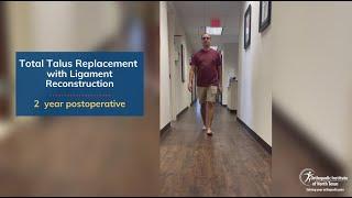 Patient 2 years after 3D total talus replacement for avascular necrosis surgery with Dr. Justin Kane