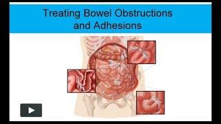 Treating Bowel Obstructions and Adhesions Non-Surgically