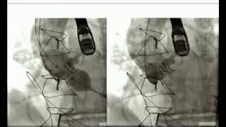 Sergey Leontyev. Transcatheter and transapical aortic valve disease