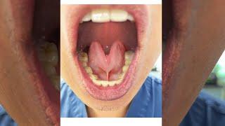 Tongue Tie: Severity Grades 1-4 (Tongue Range of Motion Ratio)