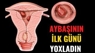 Endometrial Polip - Xanımlar Bunu Mütləq bilməlisiniz!