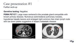 Advanced Prostate Cancer Cases