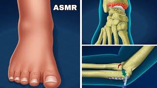 ASMR Treatment athlete's foot and warts between toes at home | Foot care animation