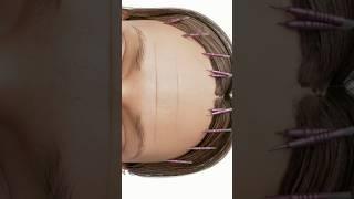 Which procedure makes more sense?     A) Brow Thread Lift, B) Direct Brow Lift C)Neither.