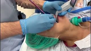 Safer Intubation with Voir Bougie® – Anywhere, Any Laryngoscope
