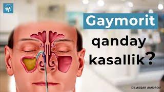 Gaymorit qanday kasallik? Gaymorit haqida biz bilmagan faktlar | Dr. Ashurov