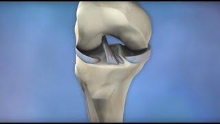 ACL Injury Prevention - Mayo Clinic