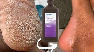 TRY HYDROGEN PEROXIDE ON YOUR FEET AND SEE WHAT HAPPENS *Shocking*