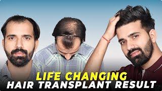 Desirable Hair Transplant Result | Best Hair Transplant Clinic in india