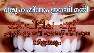 TEETH CLEANING IN MALAYALAM / പല്ലിലെ കറ പെട്ടെന്ന് കളയാം