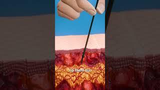 How To Remove Porcupine Quills 