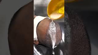 Expert Tips for First Shampoo After Hair Transplant | Cara Clinic