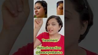 Retinol Gone Wrong Part 4: How I Treated My Retinol Allergy & Healed My Skin #retinolpurge #allergy