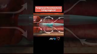 AngioJet Peripheral Thrombectomy System 🩸
